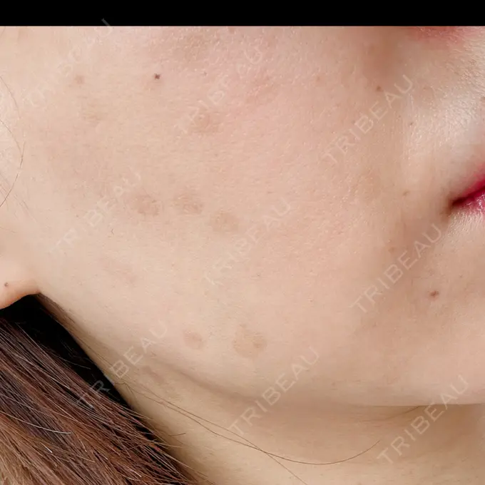 ピコレーザートーニング（美白・肝斑） G MEDICAL ART クリニック 新宿院 DAY 77 メイン用