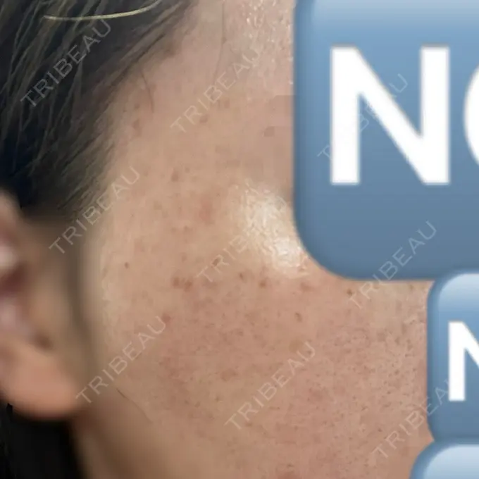 ピーリング（ニキビ・毛穴） / ルメッカ ルラ美容クリニック 仙台院 / ルラスキンクリニック 仙台院 AFTER メイン用