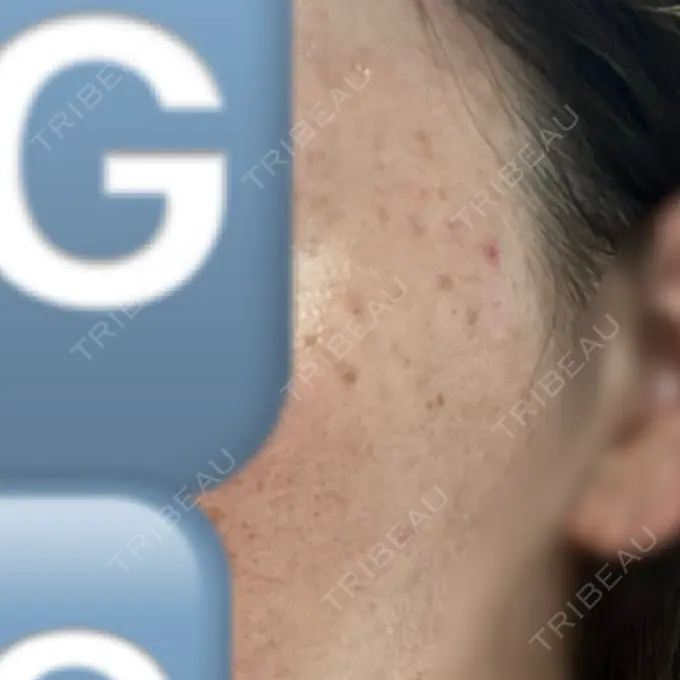 ピーリング（ニキビ・毛穴） / ルメッカ ルラ美容クリニック 仙台院 / ルラスキンクリニック 仙台院 DAY 0 メイン用