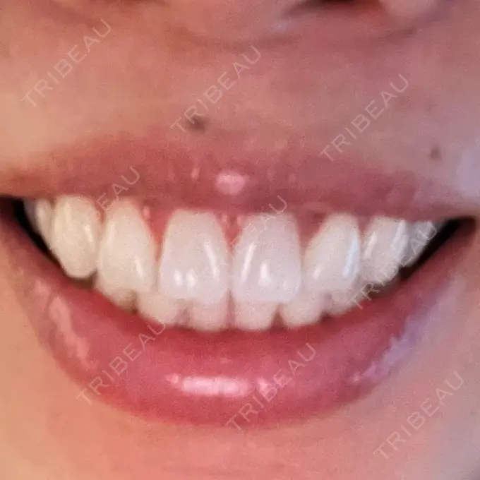 ホワイトニング LEAGRANT CLINIC 中目黒 AFTER メイン用