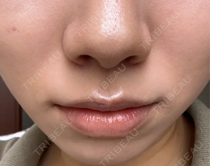 人中短縮 もとび美容外科クリニック 新宿院 DAY 30 メイン用