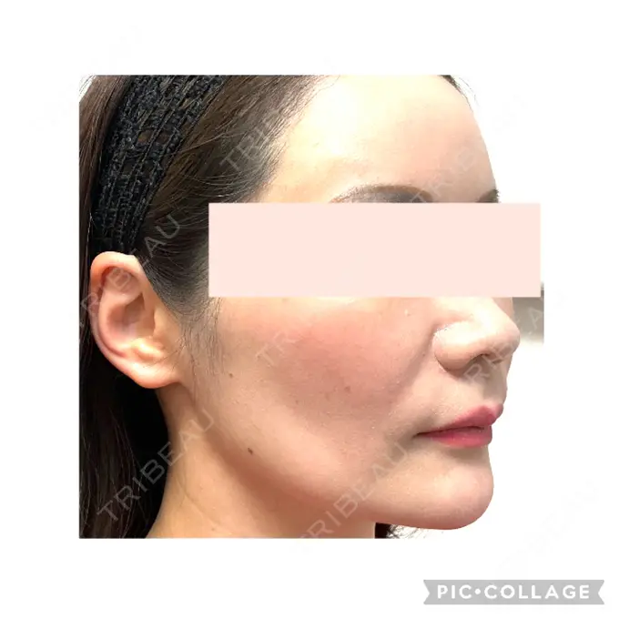 ボトックス（口角） / ボトックス（眉間） / ボトックス（目尻） / ボトックス（額） / その他（鼻） M'sクリニック【エムズクリニック】 DAY 0 メイン用