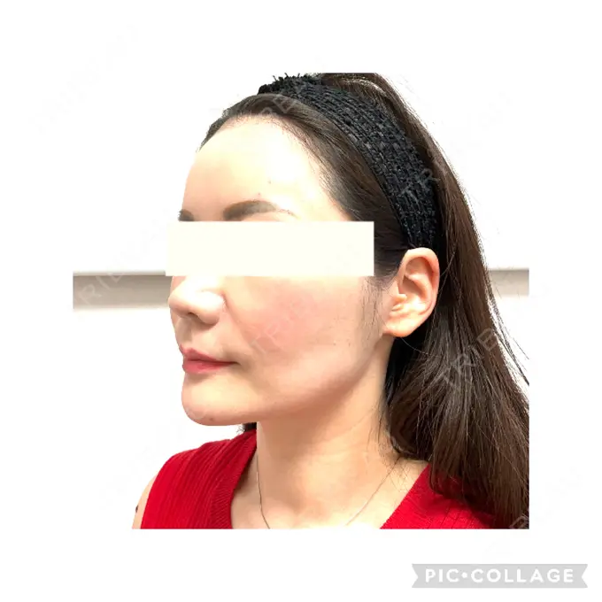 ボトックス（口角） / ボトックス（眉間） / ボトックス（目尻） / ボトックス（額） / その他（鼻） M'sクリニック【エムズクリニック】 DAY 0 メイン用