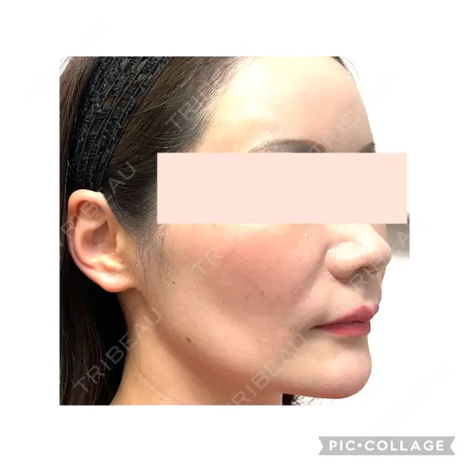 ボトックス（口角） / ボトックス（眉間） / ボトックス（目尻） / ボトックス（額） / その他（鼻） M'sクリニック【エムズクリニック】 AFTER メイン用