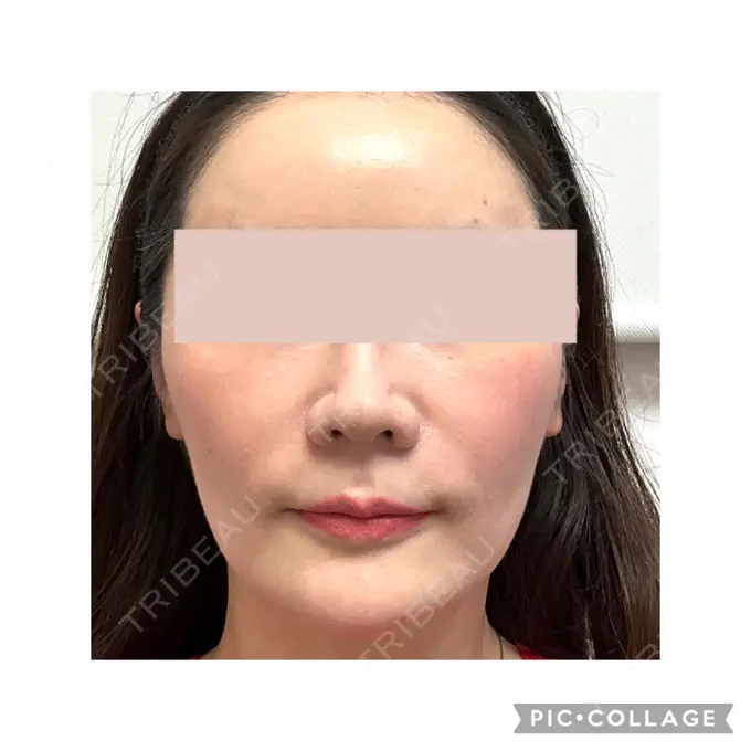 ボトックス（口角） / ボトックス（眉間） / ボトックス（目尻） / ボトックス（額） / その他（鼻） M'sクリニック【エムズクリニック】 DAY 35 メイン用