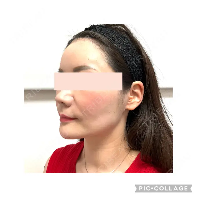 ボトックス（口角） / ボトックス（眉間） / ボトックス（目尻） / ボトックス（額） / その他（鼻） M'sクリニック【エムズクリニック】 DAY 35 メイン用