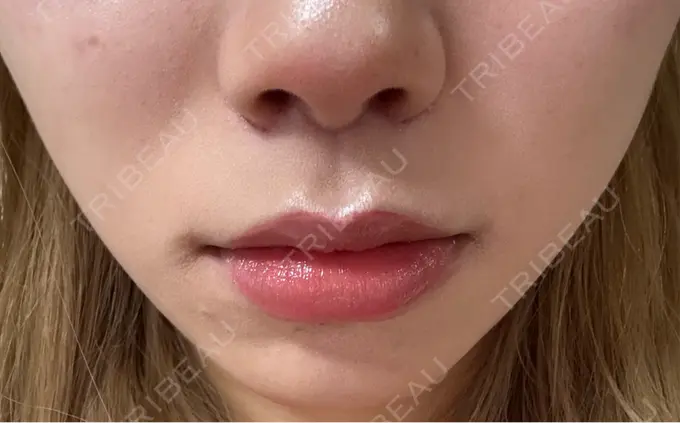 人中短縮 もとび美容外科クリニック 新宿院 DAY 31 メイン用