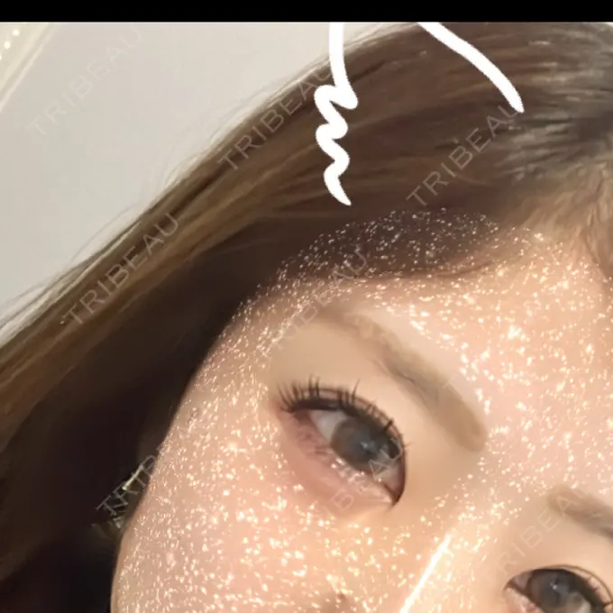 ヒアルロン酸注入（涙袋） YBC横浜美容外科 立川院 AFTER メイン用