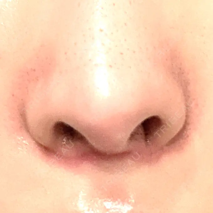 人中短縮 / 目尻切開 / ヒアルロン酸注入（鼻翼基部） 新宿ラクル美容外科クリニック 六本木院 AFTER メイン用