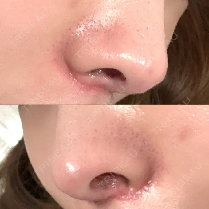 人中短縮 / 目尻切開 / ヒアルロン酸注入（鼻翼基部） 新宿ラクル美容外科クリニック 六本木院 DAY 40 メイン用