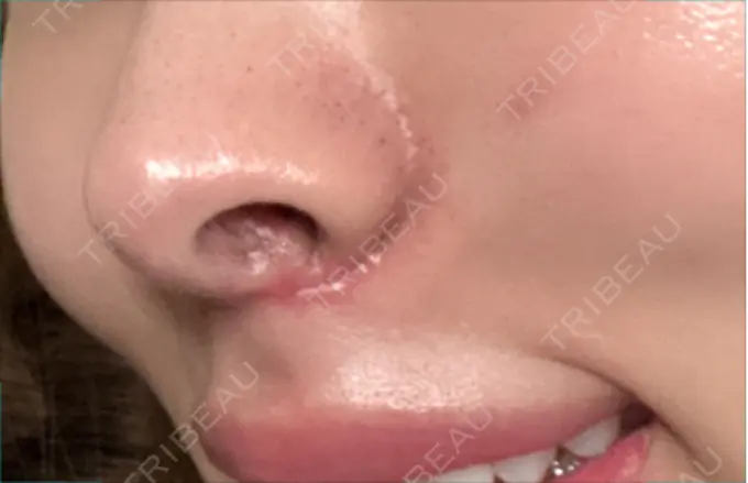 人中短縮 / 目尻切開 / ヒアルロン酸注入（鼻翼基部） 新宿ラクル美容外科クリニック 六本木院 DAY 40 メイン用