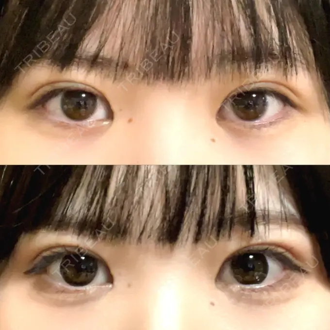 二重埋没 / 目頭切開 東京シンデレラ美容外科 池袋院 DAY 31 メイン用