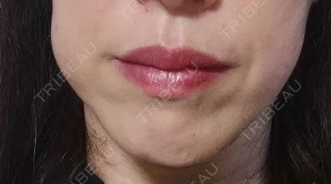 ボトックス（エラ・小顔） TCB東京中央美容外科 金山院 DAY 61 メイン用