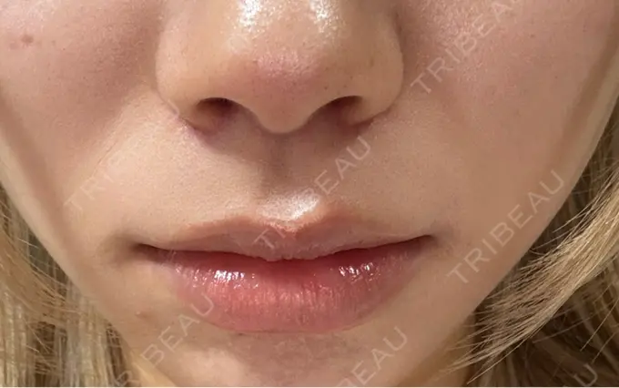 人中短縮 もとび美容外科クリニック 新宿院 DAY 32 メイン用