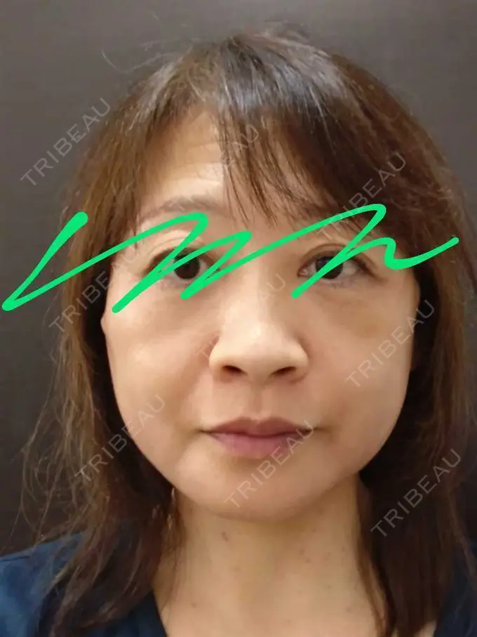 切開リフト / 肌ヒアルロン酸注入（たるみ・シワ改善） / 美肌レーザー 石倉クリニック 水戸院 DAY 21 メイン用