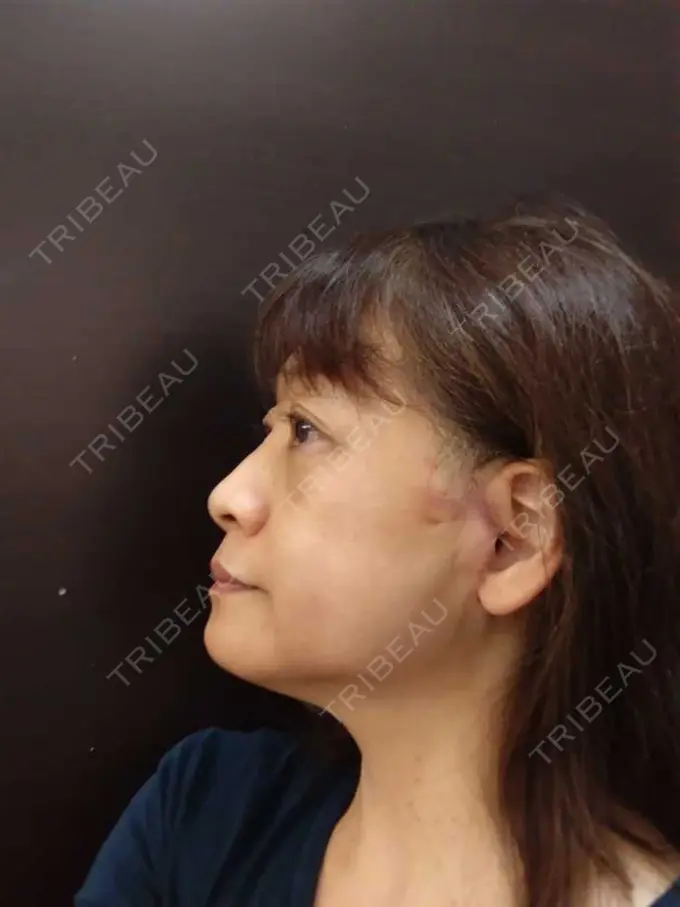 切開リフト / 肌ヒアルロン酸注入（たるみ・シワ改善） / 美肌レーザー 石倉クリニック 水戸院 DAY 21 メイン用