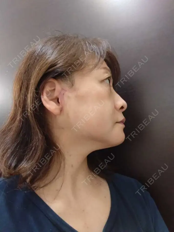 切開リフト / 肌ヒアルロン酸注入（たるみ・シワ改善） / 美肌レーザー 石倉クリニック 水戸院 DAY 21 メイン用