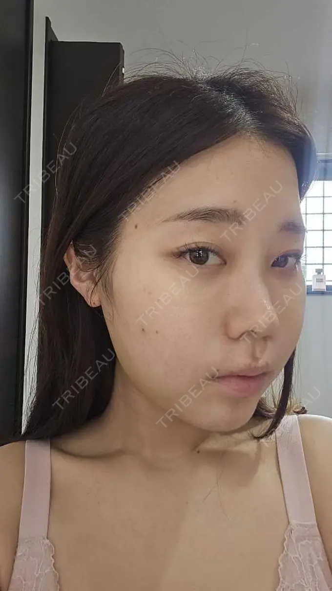 糸リフト / 脂肪吸引（顔） / ボトックス（エラ・小顔） RIVER CLINIC（リバークリニック） DAY 5 メイン用