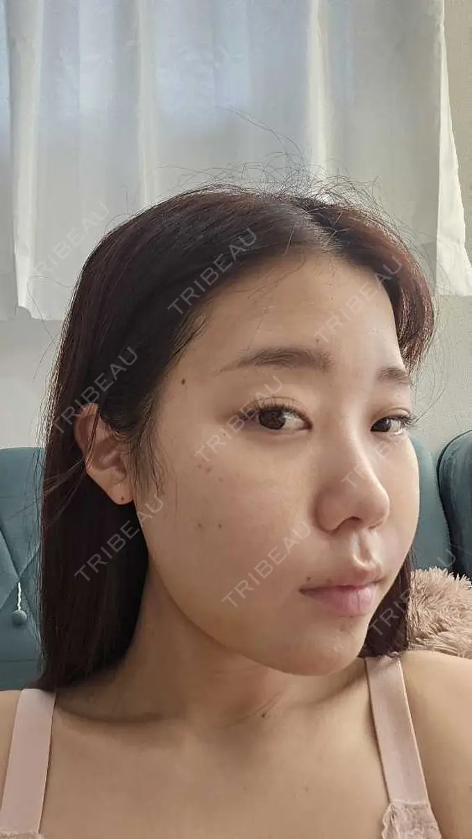 糸リフト / 脂肪吸引（顔） / ボトックス（エラ・小顔） RIVER CLINIC（リバークリニック） DAY 6 メイン用