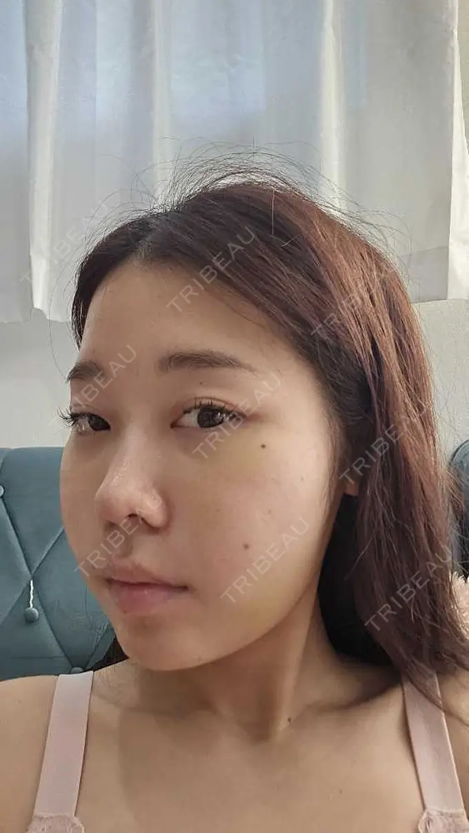 糸リフト / 脂肪吸引（顔） / ボトックス（エラ・小顔） RIVER CLINIC（リバークリニック） DAY 6 メイン用