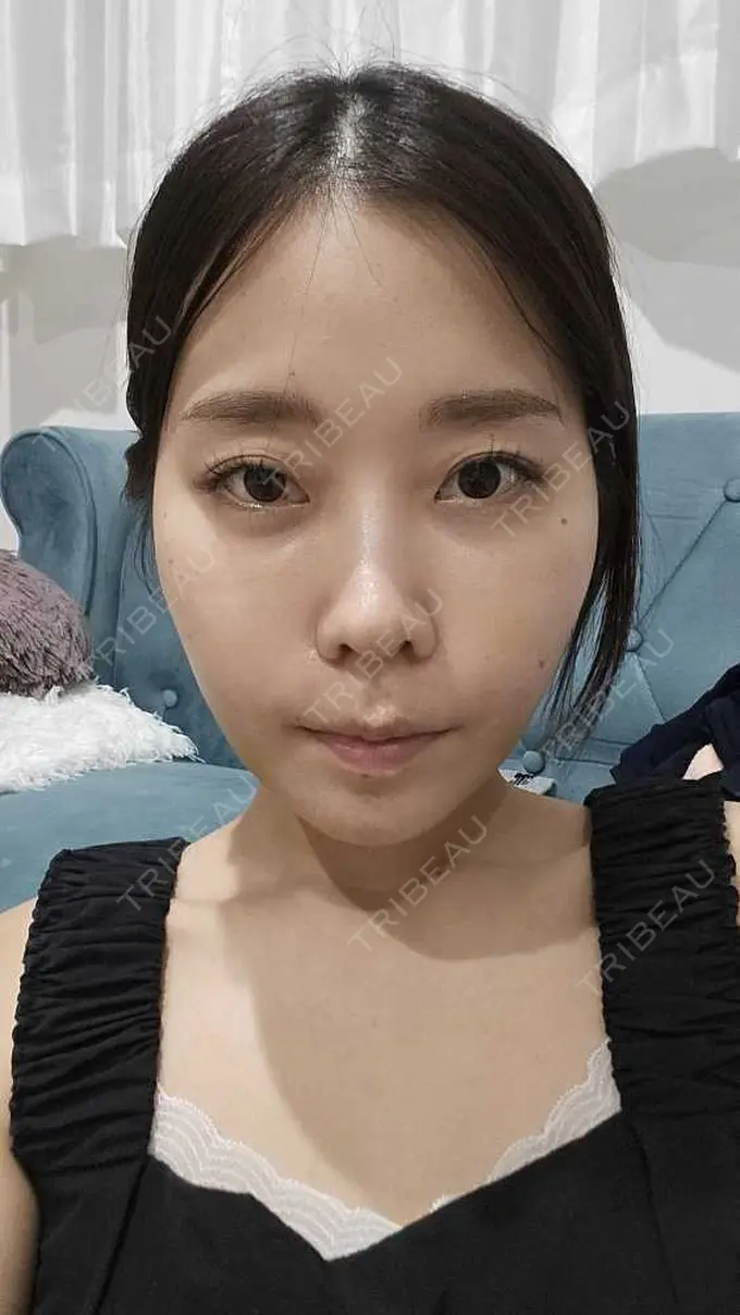 糸リフト / 脂肪吸引（顔） / ボトックス（エラ・小顔） RIVER CLINIC（リバークリニック） DAY 7 メイン用