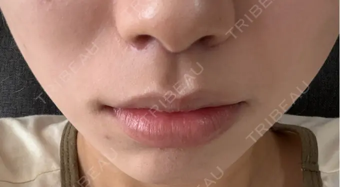 人中短縮 もとび美容外科クリニック 新宿院 DAY 33 メイン用