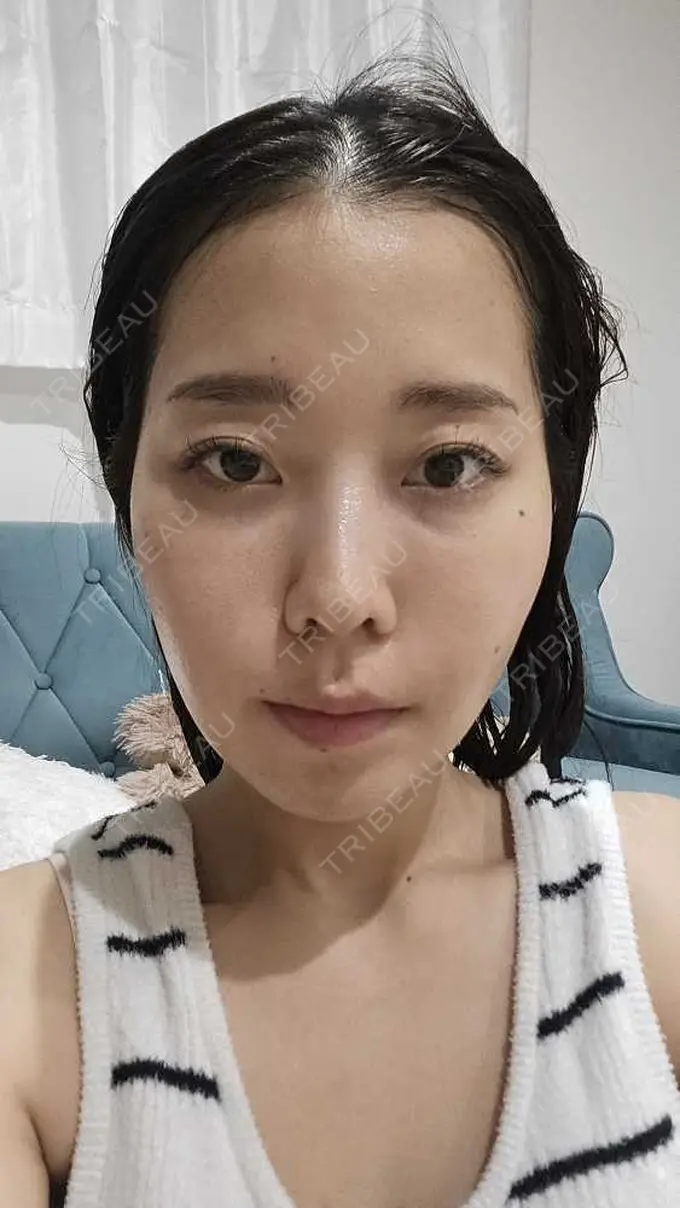 糸リフト / 脂肪吸引（顔） / ボトックス（エラ・小顔） RIVER CLINIC（リバークリニック） DAY 9 メイン用