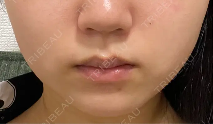 ボトックス（エラ・小顔） TCB東京中央美容外科 仙台駅前院 DAY 22 メイン用