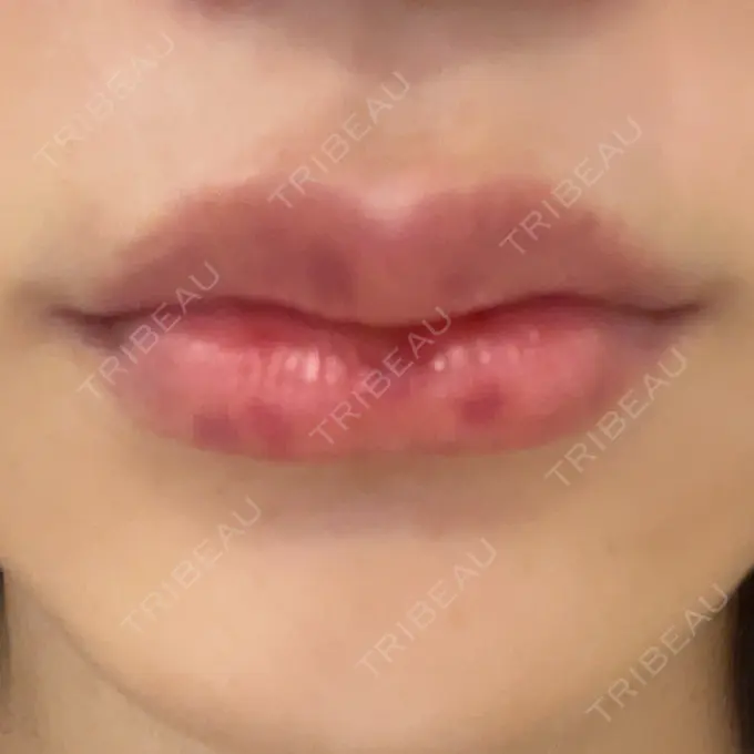 ヒアルロン酸注入（唇） R Beauty CLINIC 銀座院 DAY 6 メイン用
