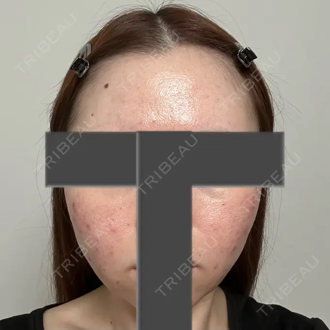 ニードルRF（ポテンツァなど） 東京美容外科 池袋院 AFTER メイン用