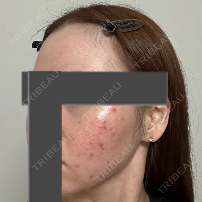 ニードルRF（ポテンツァなど） 東京美容外科 池袋院 DAY 31 メイン用