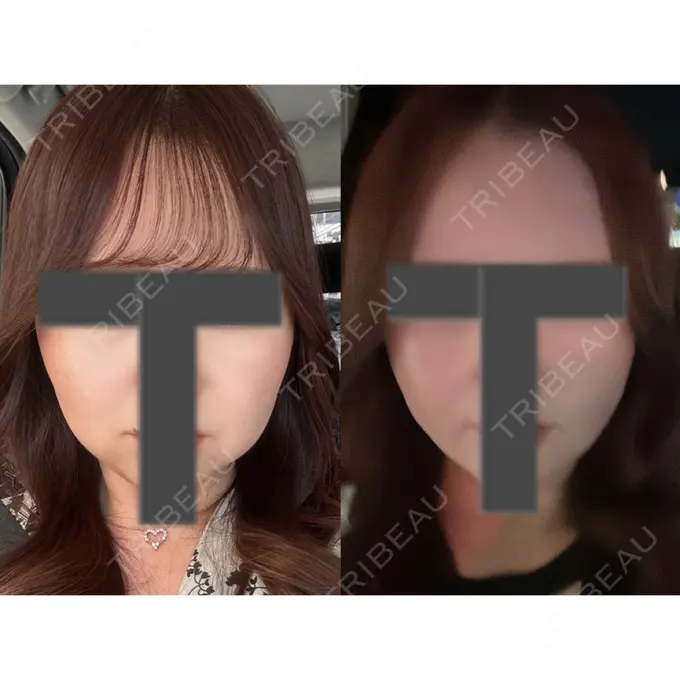 脂肪吸引（顔） / ジョールファット除去 / ヒアルロン酸注入（あご） / ボトックス（エラ・小顔） Otus Clinic 【オータスクリニック】 AFTER メイン用