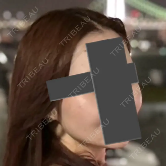 脂肪吸引（顔） / ジョールファット除去 / ヒアルロン酸注入（あご） / ボトックス（エラ・小顔） Otus Clinic 【オータスクリニック】 DAY 290 メイン用