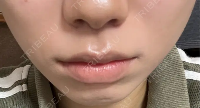 人中短縮 もとび美容外科クリニック 新宿院 DAY 34 メイン用