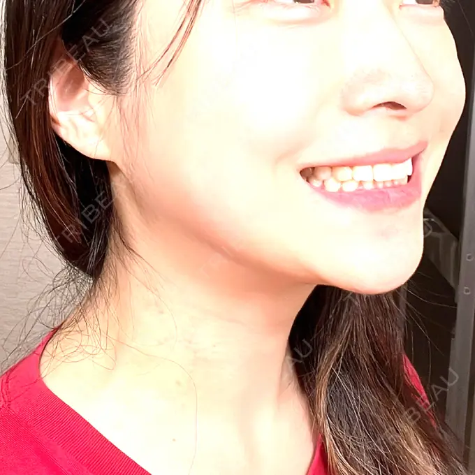 ボトックス（エラ・小顔） / ボトックス（口角） / ボトックス（肩） / その他（鼻） M'sクリニック【エムズクリニック】 AFTER メイン用