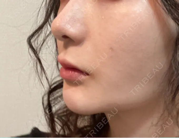 ヒアルロン酸注入（鼻翼基部） バログ医院 江南院 DAY 45 メイン用