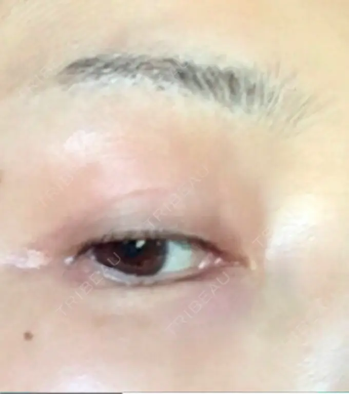 眉下切開 湘南美容クリニック 秋葉原院 DAY 918 メイン用