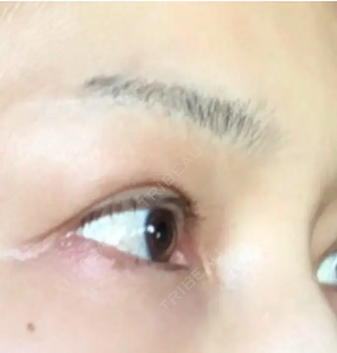 眉下切開 湘南美容クリニック 秋葉原院 DAY 918 メイン用