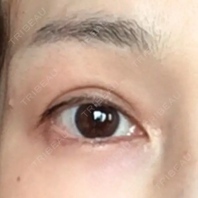 眉下切開 湘南美容クリニック 秋葉原院 DAY 918 メイン用