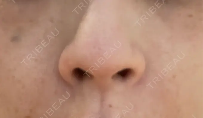 その他（肌） 美容皮膚科エルムクリニック 岡山院 DAY 2 メイン用