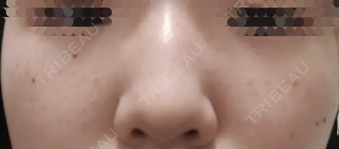 ピーリング（ハリ・ツヤ） / ルメッカ ルラ美容クリニック 仙台院 / ルラスキンクリニック 仙台院 DAY 2 メイン用