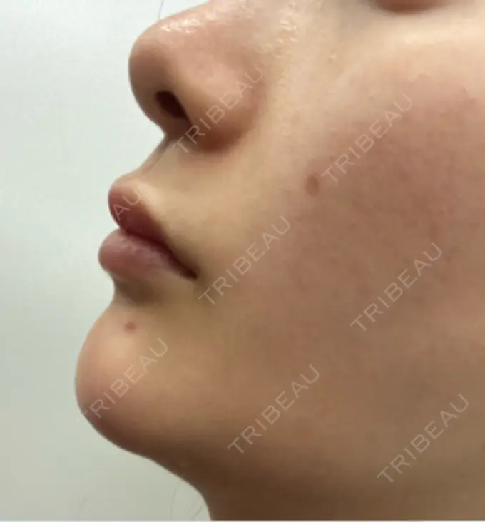 ヒアルロン酸注入（鼻翼基部） バログ医院 江南院 DAY 56 メイン用