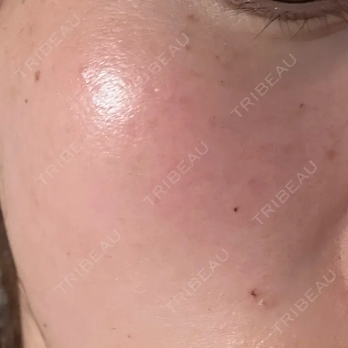 ピーリング（ハリ・ツヤ） ルラ美容クリニック 仙台院 / ルラスキンクリニック 仙台院 AFTER メイン用