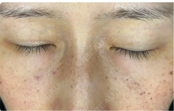 イオン導入 / ルメッカ ルラ美容クリニック 静岡院 DAY 1 メイン用