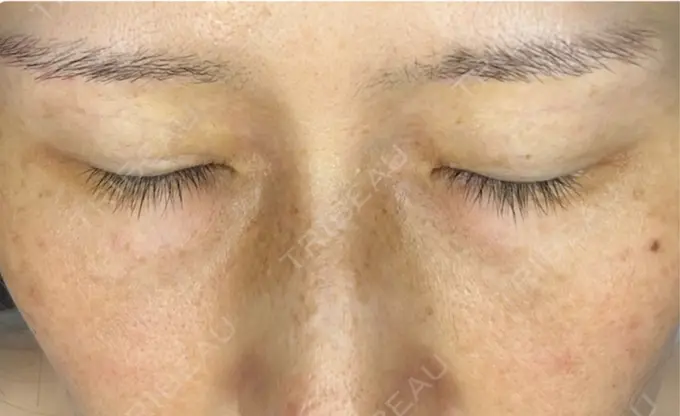 イオン導入 / ルメッカ ルラ美容クリニック 静岡院 AFTER メイン用