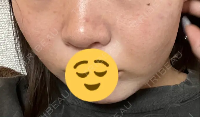 ピーリング（ニキビ・毛穴） OMI CLINIC 【オミクリニック】 DAY 28 メイン用