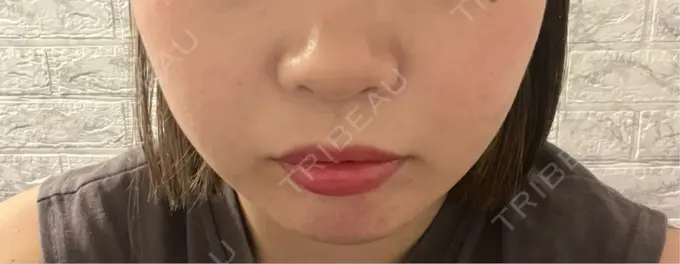 ピーリング（ニキビ・毛穴） OMI CLINIC 【オミクリニック】 DAY 28 メイン用