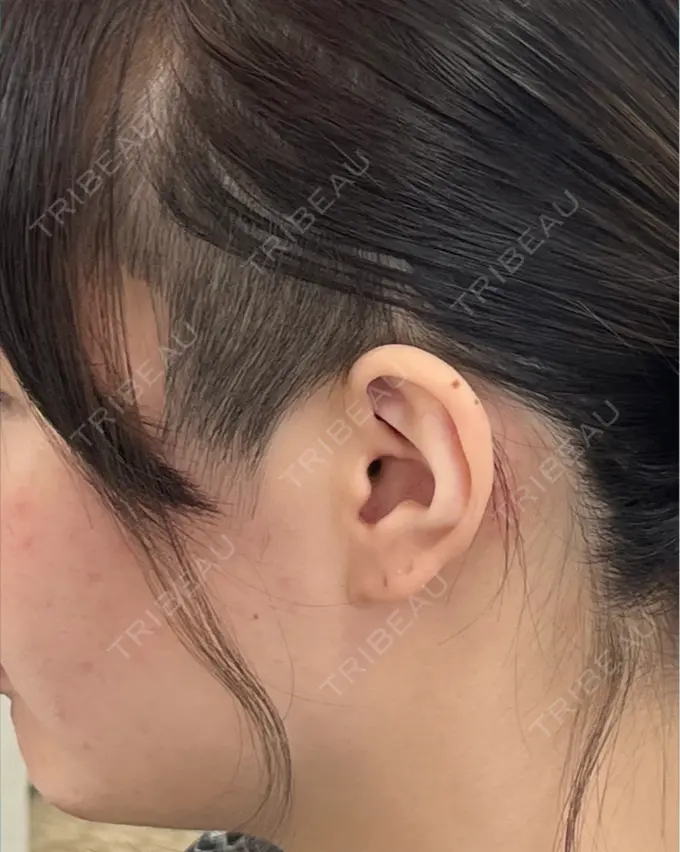 ピーリング（ニキビ・毛穴） OMI CLINIC 【オミクリニック】 AFTER メイン用