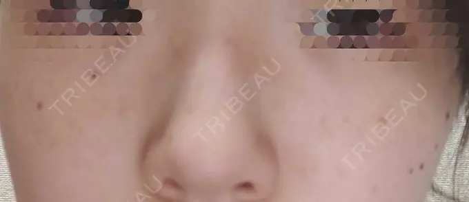 ピーリング（ハリ・ツヤ） / ルメッカ ルラ美容クリニック 仙台院 / ルラスキンクリニック 仙台院 DAY 3 メイン用