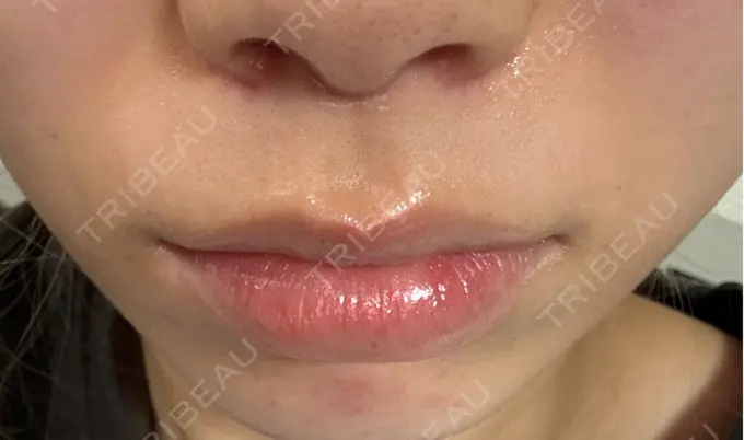 人中短縮 もとび美容外科クリニック 新宿院 AFTER メイン用